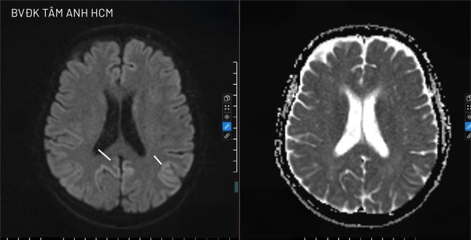 Ảnh MRI cho thấy vùng vỏ não của ông Tấn tăng tín hiệu dạng dải sáng đặc trưng của bệnh Creutzfeldt-Jakob. Ảnh: Bệnh viện Đa khoa Tâm Anh