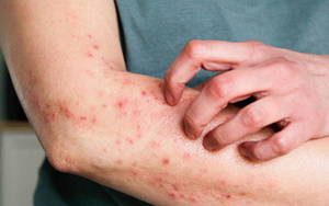 Thu hồi giấy đăng ký lưu hành 17 thuốc theo Quyết định của Cục Quản lý Dược - Ảnh 3.