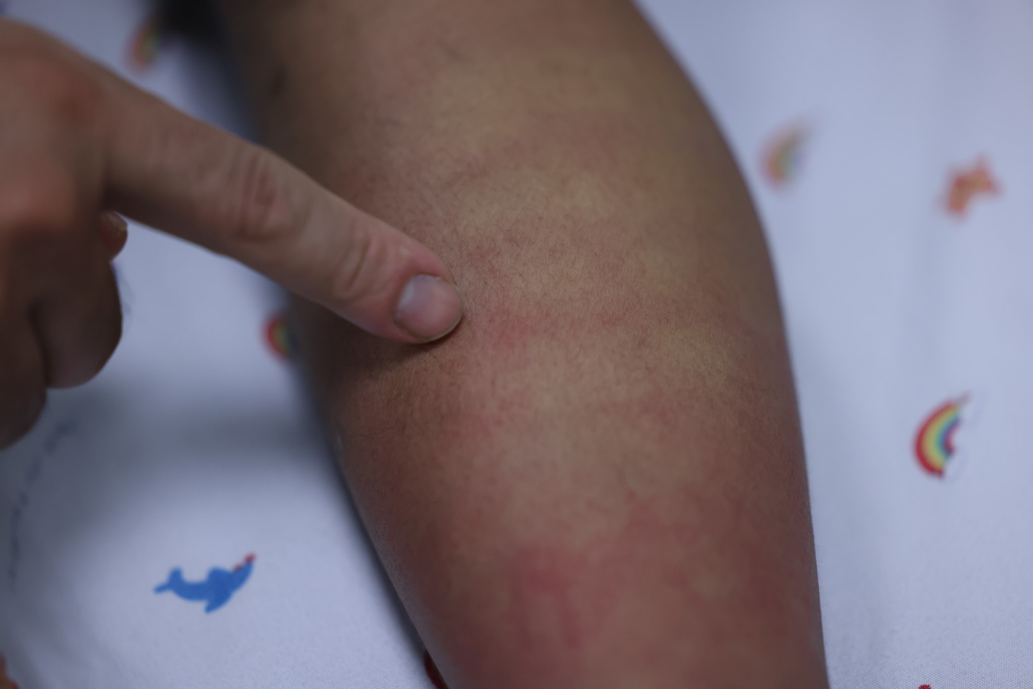 Sốt xuất huyết Dengue có triệu chứng khởi phát tương đồng với nhiều bệnh khác như cảm cúm, sốt siêu vi, khiến nhiều người dễ chủ quan, đến khám tại cơ sở y tế trong giai đoạn muộn.