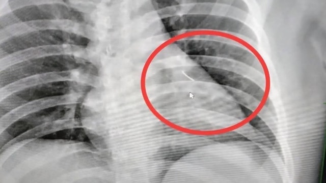 Người đàn ông bị đau ngực, bác sĩ sốc nặng khi phát hiện ra thứ bên trong - Ảnh 1.