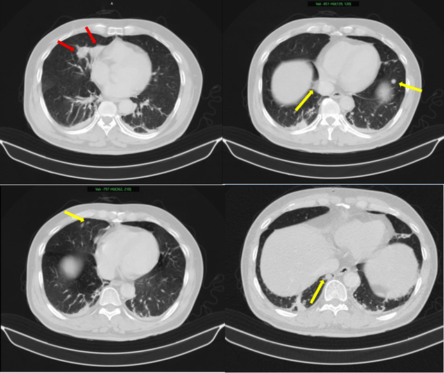 Người đàn ông 63 tuổi sốc nặng khi phát hiện mắc hai bệnh ung thư cùng lúc - Ảnh 1.