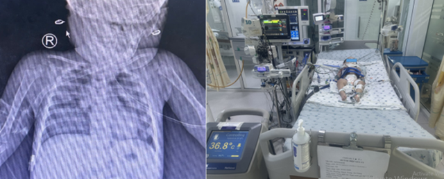 Bé gái hơn 1 tuổi nguy kịch vì phút lơ là của người lớn, bác sĩ cảnh báo thói quen "chết người"- Ảnh 1. Bé gái hơn 1 tuổi nguy kịch vì phút lơ là của người lớn, bác sĩ cảnh báo thói quen "chết người"- Ảnh 1.