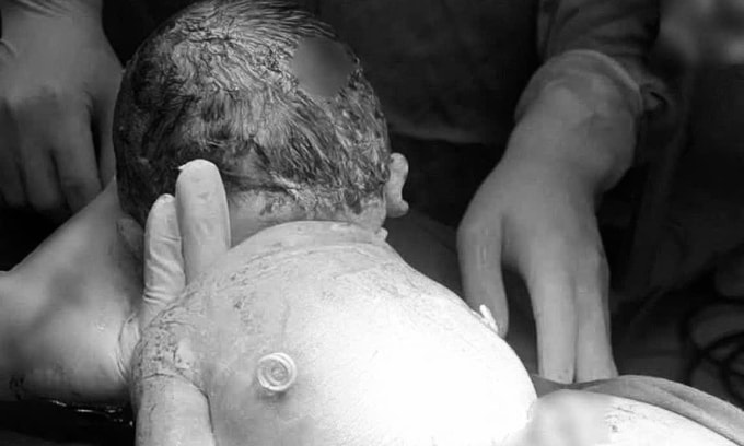 Em bé chào đời với hai ống dẫn lưu như đôi cánh trên lưng. Ảnh: Bệnh viện cung cấp