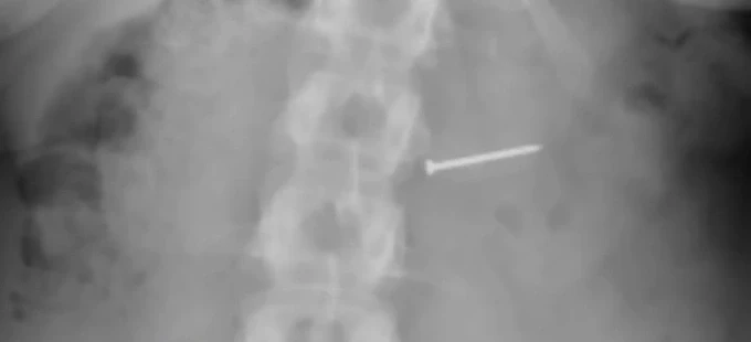 Hình ảnh chụp X quang của Brandy Buckley. Ảnh: NYPost