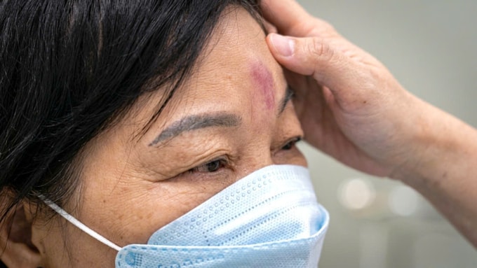 Một trường hợp tắc mạch tiêm filler nhập viện BV Da liễu TP HCM. Ảnh: Bệnh viện cung cấp