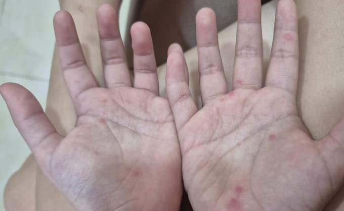Trẻ mắc tay chân miệng nổi hồng ban ở lòng bàn tay. Ảnh: Lê Phương