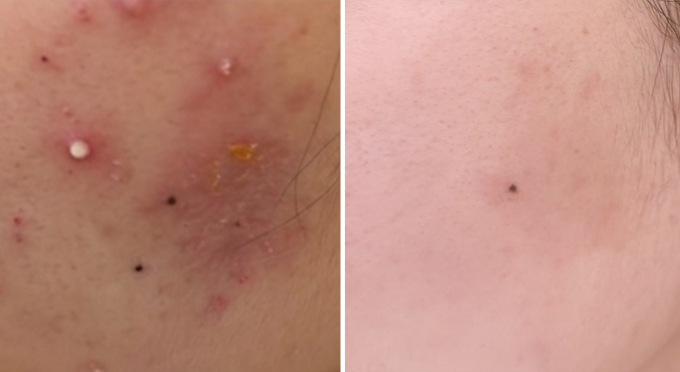 Tình trạng viêm, mụn mủ của chị Mến đã hết sau một tháng điều trị. Ảnh: Bệnh viện Đa khoa Tâm Anh