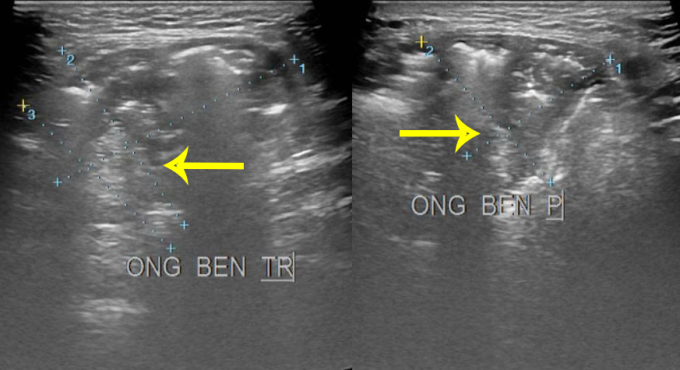 Các khối thoát vị hai bên bẹn của ông Ờ trên phim siêu âm. Ảnh: Bệnh viện Đa khoa Tâm Anh