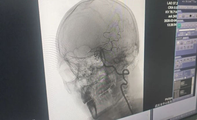 Đội ngũ y tế đã can thiệp và tái thông thành công mạch máu bị tắc của anh Vương. Ảnh: Li Huizi