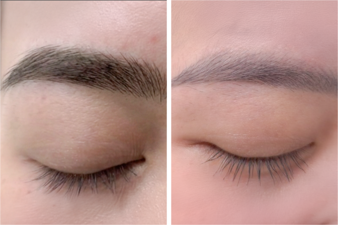 Mực xăm chân mày của chị Hồng đã nhạt hơn sau 3 lần điều trị bằng laser. Ảnh: Bệnh viện Đa khoa Tâm Anh