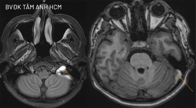 Ảnh MRI cho thấy cục huyết khối gây bít gần như hoàn toàn tĩnh mạch cảnh trong trái, lan các xoang tĩnh mạch lân cận. Ảnh: Bệnh viện Đa khoa Tâm Anh