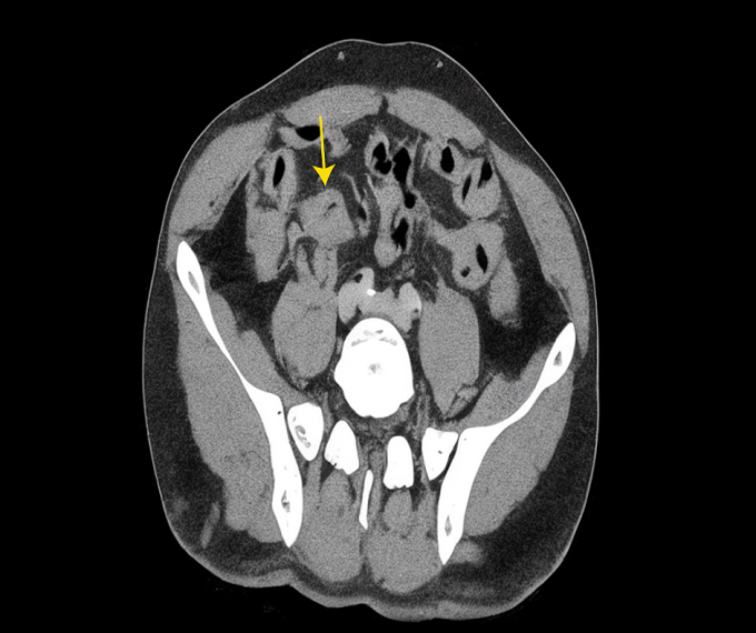 Chụp CT cho thấy khối u ở gan (mũi tên vàng). Ảnh: Bệnh viện Đa khoa Tâm Anh