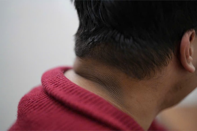 Mảng gai đen thường xuyên hiện ở người béo phì. Ảnh: Bệnh viện Đa khoa Tâm Anh