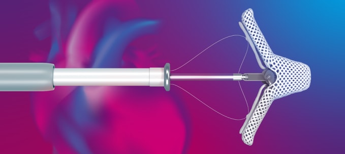 Thiết bị sửa van hai lá xâm lấn tối thiểu MitraClip. Ảnh: Abbott