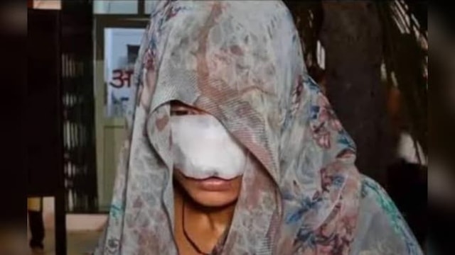 Cãi nhau, chồng cắn vào mũi và má khiến vợ phải khâu 10 mũi - Ảnh 1.