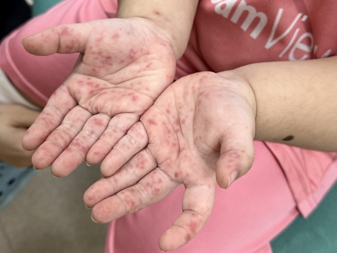 Lòng bàn tay trẻ mắc tay chân miệng, điều trị tại BV Nhi đồng Thành phố. Ảnh: BVCC