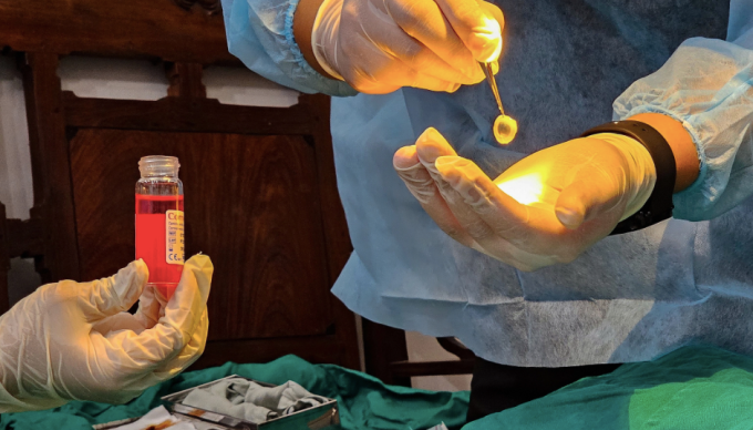 Giác mạc hiến lấy ra được đưa vào lọ bảo quản. Ảnh:Thùy Dương.