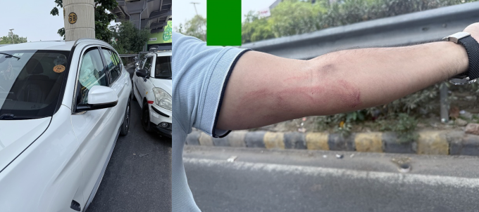 Túi khi bung do xung lực của mẫu BMW X3 2019, và vết thương trên tay tài xế do túi khi gây ra. Ảnh: Team-BHP