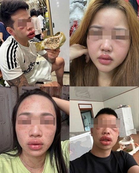 "Cơn ác mộng" từ món đặc sản khiến nhiều người phải nhập viện - Ảnh 2.