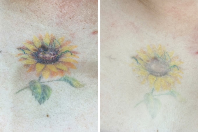 Các mực xăm màu tối đã mờ đáng kể sau ba lần xóa bằng laser pico. Ảnh: Bệnh viện Đa khoa Tâm Anh