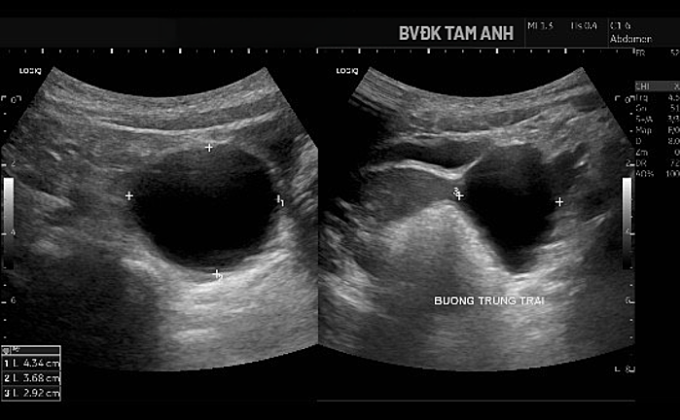 Hình siêu âm cho thấy nang buồng trứng phì đại. Ảnh: Bệnh viện Đa khoa Tâm Anh