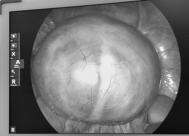 Đau bụng nhưng chủ quan, người phụ nữ sốc khi bác sĩ gắp ra thứ "đáng sợ" bên trong - Ảnh 1.