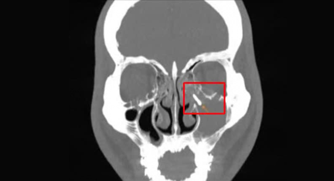 Chụp CT cho thấy dị vật ở xoang hàm bên trái của anh Phú. Ảnh: Bệnh viện Đa khoa Tâm Anh