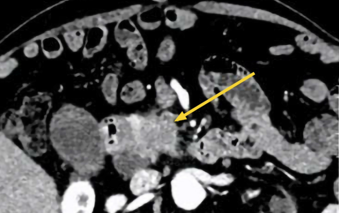 Chụp CT cho thấy đầy tụy tổn thương (mũi tên vàng)của ông Hưng. Ảnh: Bệnh viện Đa khoa Tâm Anh