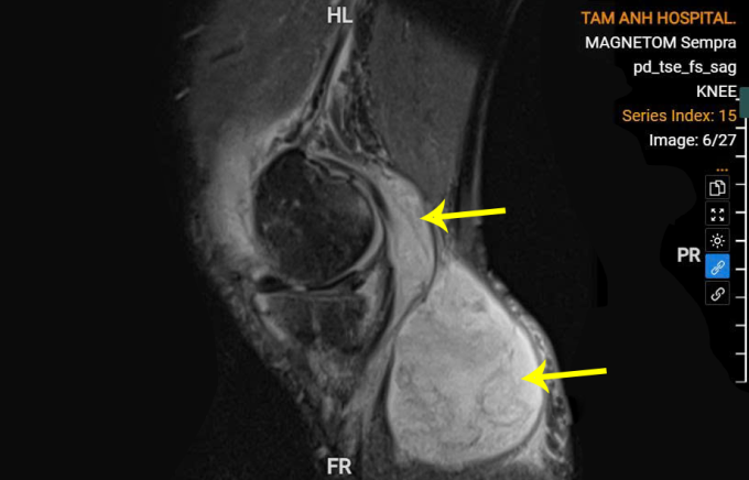 U bao hoạt dịch chứa ổ mủ lớn sau khớp gối ông Trịnh. Ảnh: Bệnh viện Đa khoa Tâm Anh