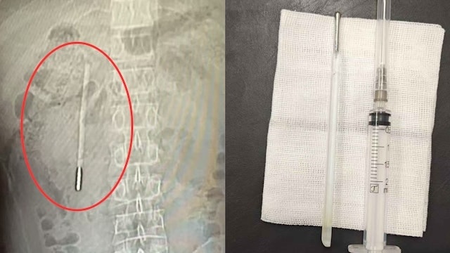 Đau bụng đi khám, người đàn ông sốc nặng khi thấy thứ bên trong - Ảnh 1.