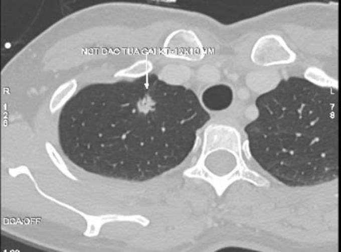 Nốt phổi nguy cơ cao của bà Liên trên phim chụp CT. Ảnh: Bệnh viện Đa khoa Tâm Anh