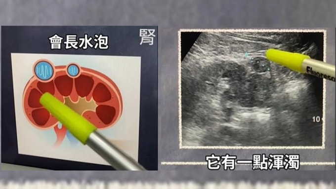 Trong quá trình siêu âm bụng cho bệnh nhân, bác sĩ Chiêm Chính Hùng nhận thấy các nang thận có dấu hiệu vẩn đục và hình dạng bất thường. Ảnh: Facebook Dr. Chien Cheng-hung