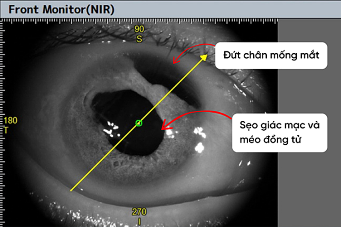 Mắt phải bệnh nhân có nhiều tổn thương nặng sau tai nạn. Ảnh: Bệnh viện cung cấp