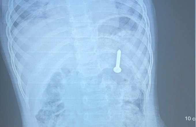 Đinh vít năm trong dạ dày bé gái. Ảnh: Bệnh viện cung cấp