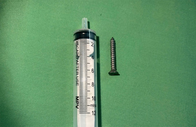 Đinh vít được lấy ra từ dạ dày bệnh nhân. Ảnh: Bệnh viên cung cấp