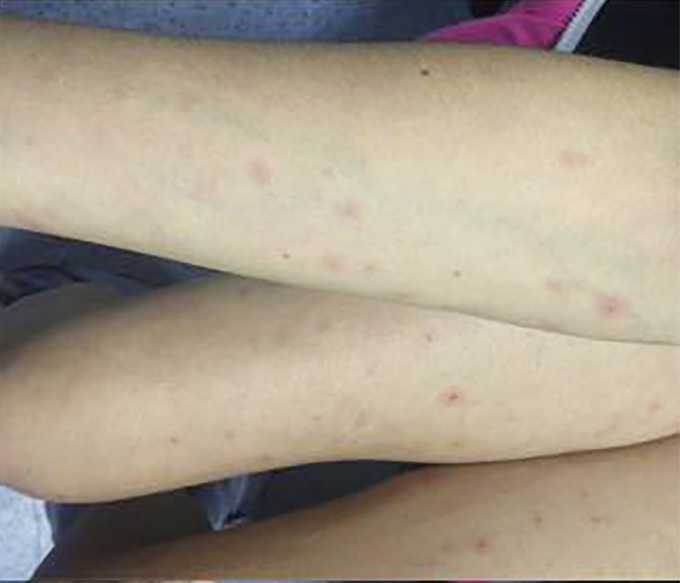 Một trường hợp nhiễm trùng dai dẳng do não mô cầu gây phát ban dạng sẩn ở tay, chân, lòng bàn tay được đăng tải tại Thư viện Y khoa quốc gia Mỹ. Ảnh: Thư viện Y khoa quốc gia Mỹ