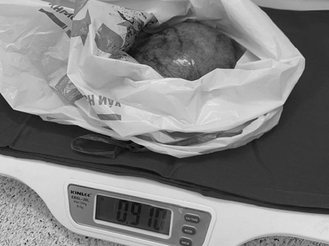 Đau bụng tưởng nhẹ, người phụ nữ sốc nặng khi bác sĩ lấy ra thứ “đáng sợ” trong bụng - Ảnh 1.