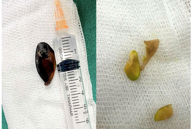 Bé 14 tuổi ho khan kéo dài, gia đình sốc khi bác sĩ lấy ra dị vật bên trong cơ thể- Ảnh 1. Bé 14 tuổi ho khan kéo dài, gia đình sốc khi bác sĩ lấy ra dị vật bên trong cơ thể- Ảnh 1.