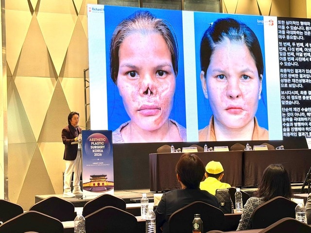 Giải pháp điều trị biến chứng sau nâng mũi gây chú ý tại Hội nghị thẩm mỹ quốc tế APS Korea 2026 - Ảnh 1.
