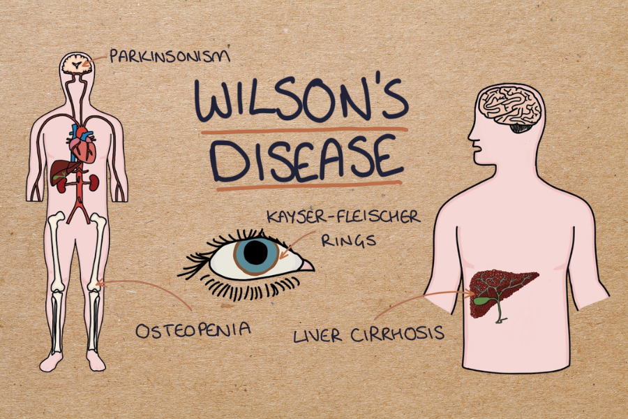 Bệnh Wilson: Căn bệnh hiếm dễ bị nhầm lẫn với các bệnh lý về gan 