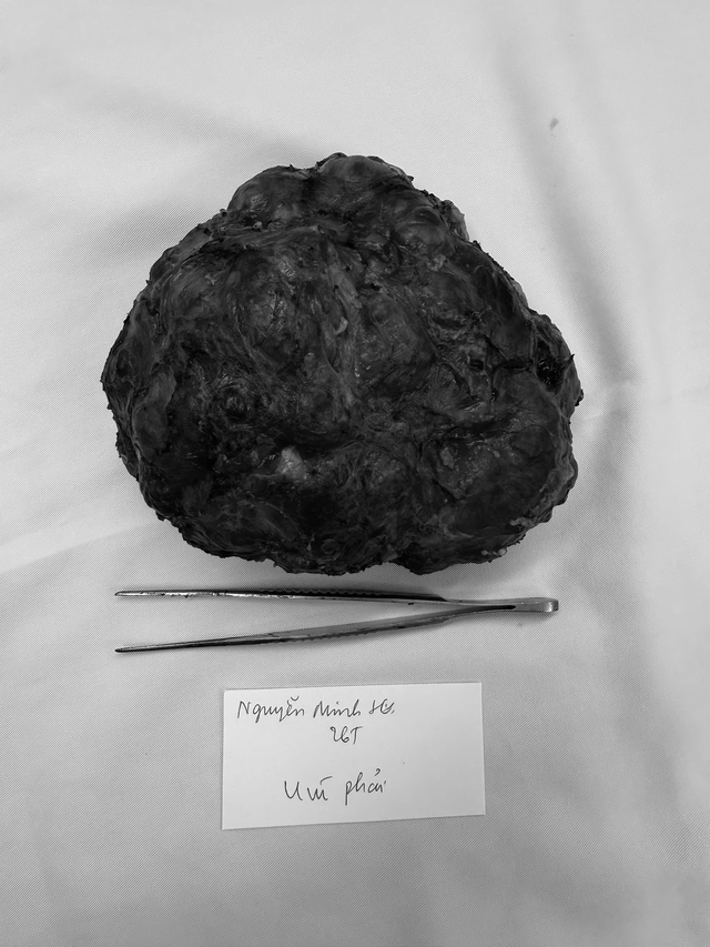 Cô gái trẻ 26 tuổi vòng một to bất thường, bác sĩ phát hiện bí mật bên trong - Ảnh 1.