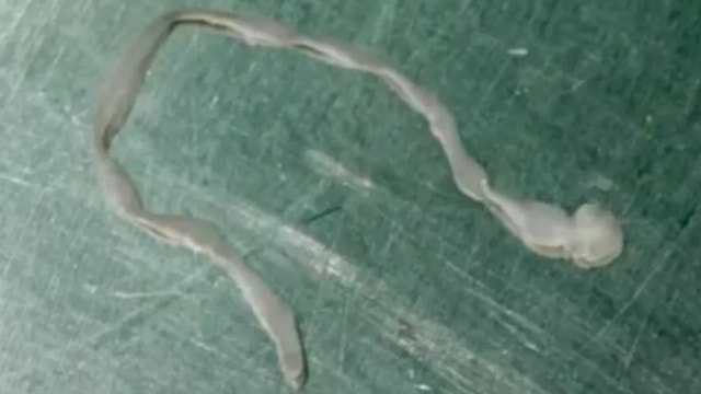 Người phụ nữ lên cơn co giật, bác sĩ lấy ra thứ đáng sợ trong não - Ảnh 1.