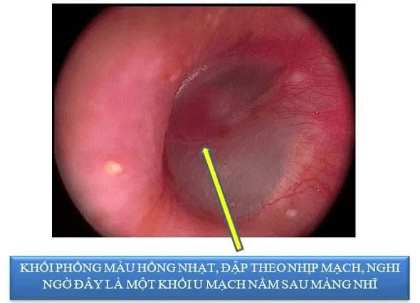 các bác sĩ phát hiện phía sau màng nhĩ trái có một khối phồng màu hồng nhạt, đập theo nhịp mạch