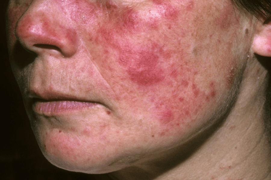 Bệnh lupus ban đỏ xảy ra khi hệ miễn dịch tấn công nhầm vào các mô và cơ quan khỏe mạnh của chính cơ thể.