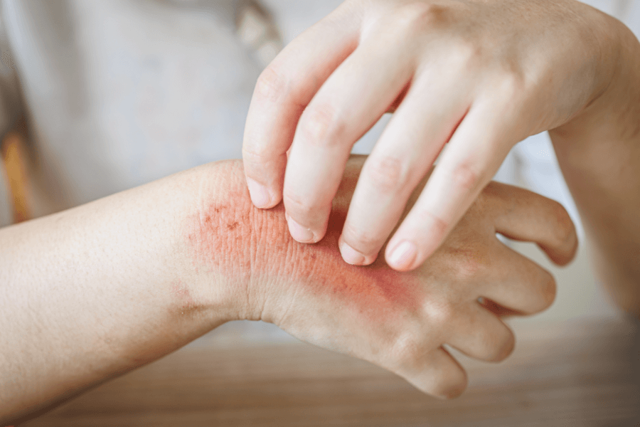 9 kiểu dị ứng kỳ lạ nghe khó tin nhưng có thật