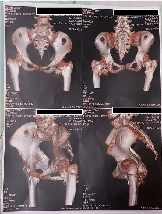 Hình ảnh dựng hình 3D từ chụp cắt lớp vi tính (CT) vùng khung chậu và khớp háng của bệnh nhân với hình ảnh canxi hóa mô mềm quanh khớp. (Ảnh: Bệnh viện Nhi đồng Thành phố)