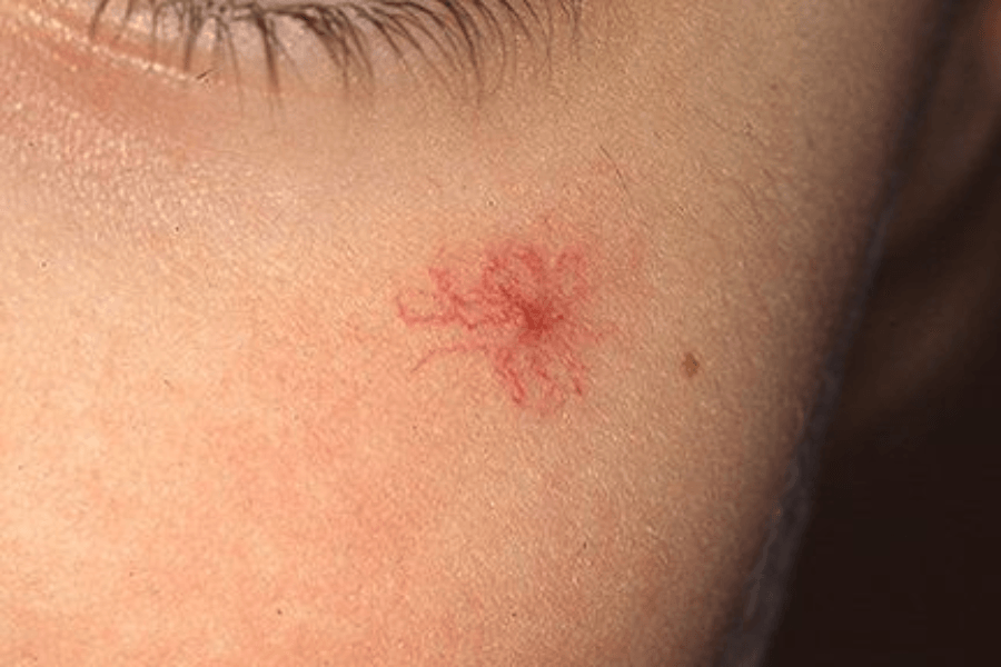 Nốt mạch hình nhện, còn gọi là spider angioma, thường có một chấm đỏ ở giữa với các mạch máu nhỏ tỏa ra xung quanh như chân nhện
