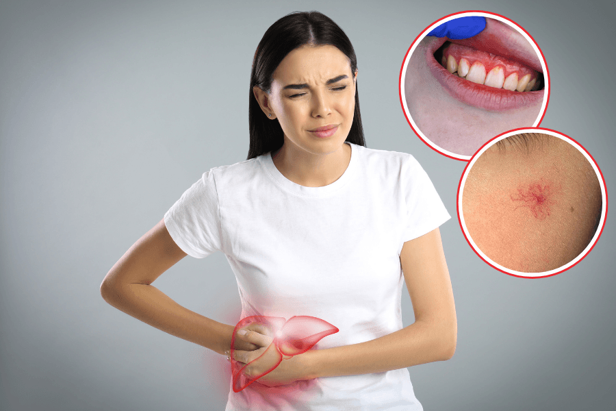 Vì sao bệnh gan có thể gây chảy máu chân răng và xuất hiện nốt mạch hình nhện trên da? 
