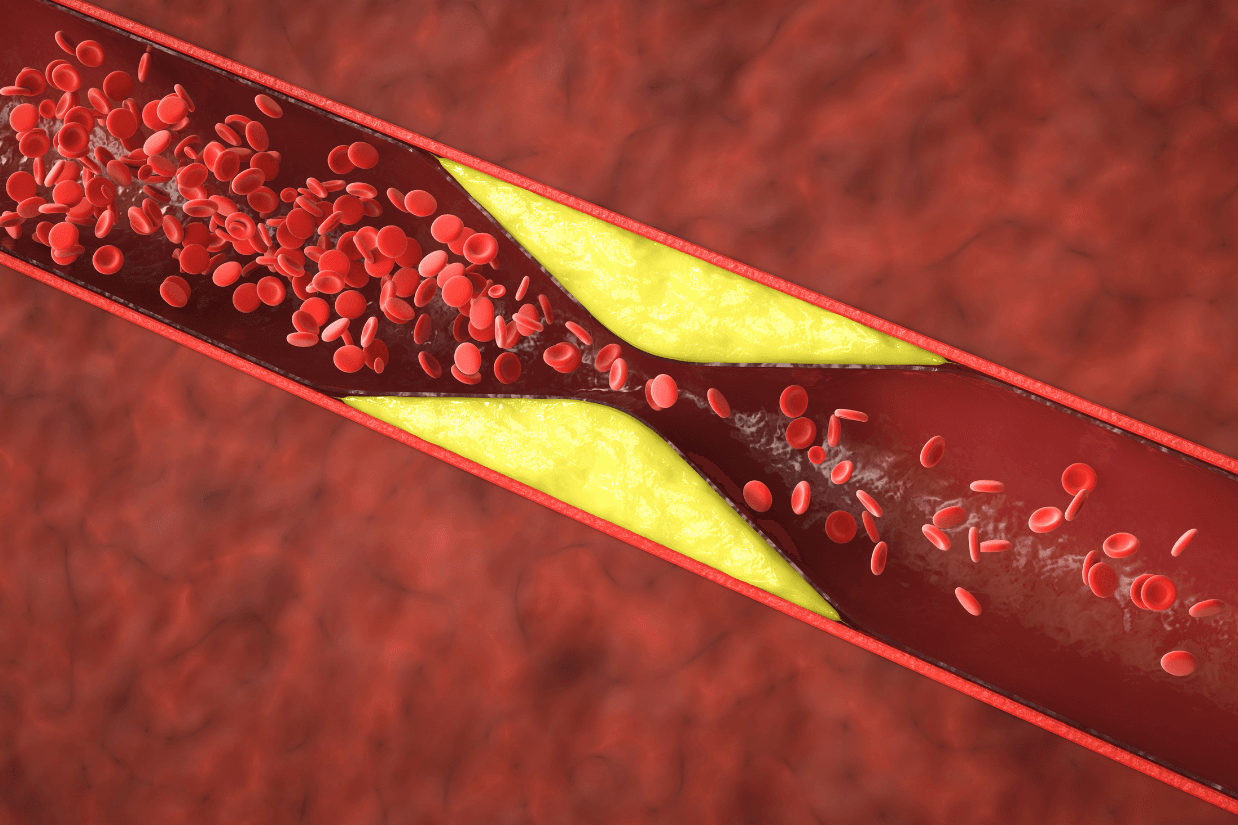 khi lượng cholesterol được vận chuyển trong các hạt LDL quá cao, chúng có thể cùng các chất khác tạo thành mảng xơ vữa