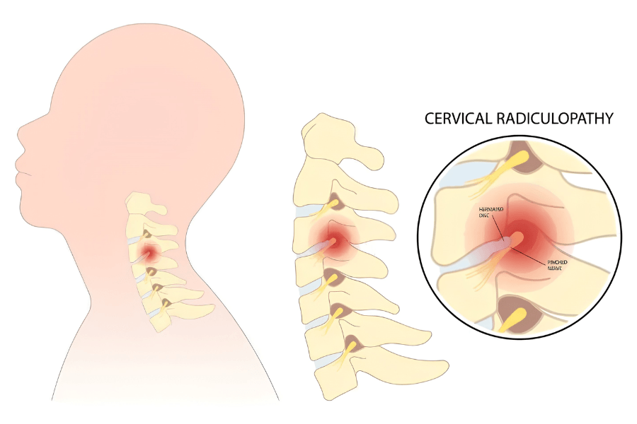 Chèn ép hoặc kích thích rễ thần kinh cổ có thể gây đau từ cổ lan xuống vai và cánh tay, kèm châm chích, tê hoặc yếu ở bàn tay